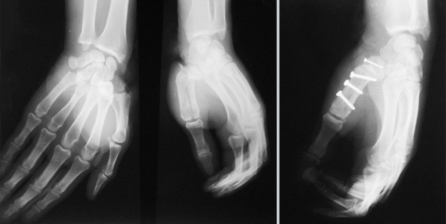 Osteosinteza vijcima
